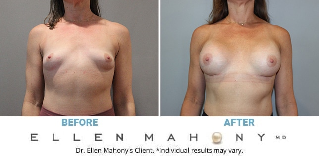 Breast Procedures Archives - DrEllenMahony.com