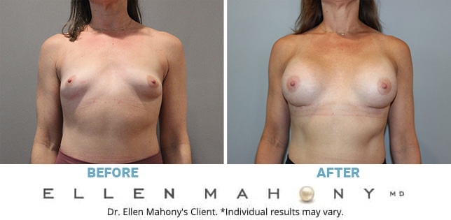 644px x 315px - Breast Procedures Archives - DrEllenMahony.com