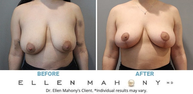 Breast Augmentation Archives 
