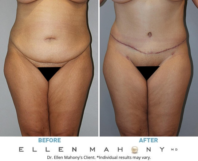 Before and After Image: Case #12856 - front