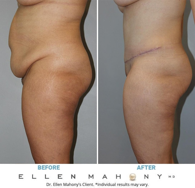 Before and After Image: Case #12856 - left-side