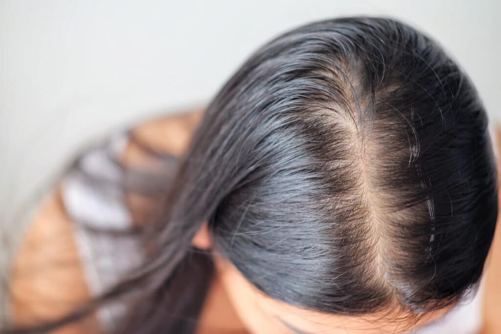 Top view of a woman with thinning hair along the part line, showing visible scalp and reduced hair density near the crown