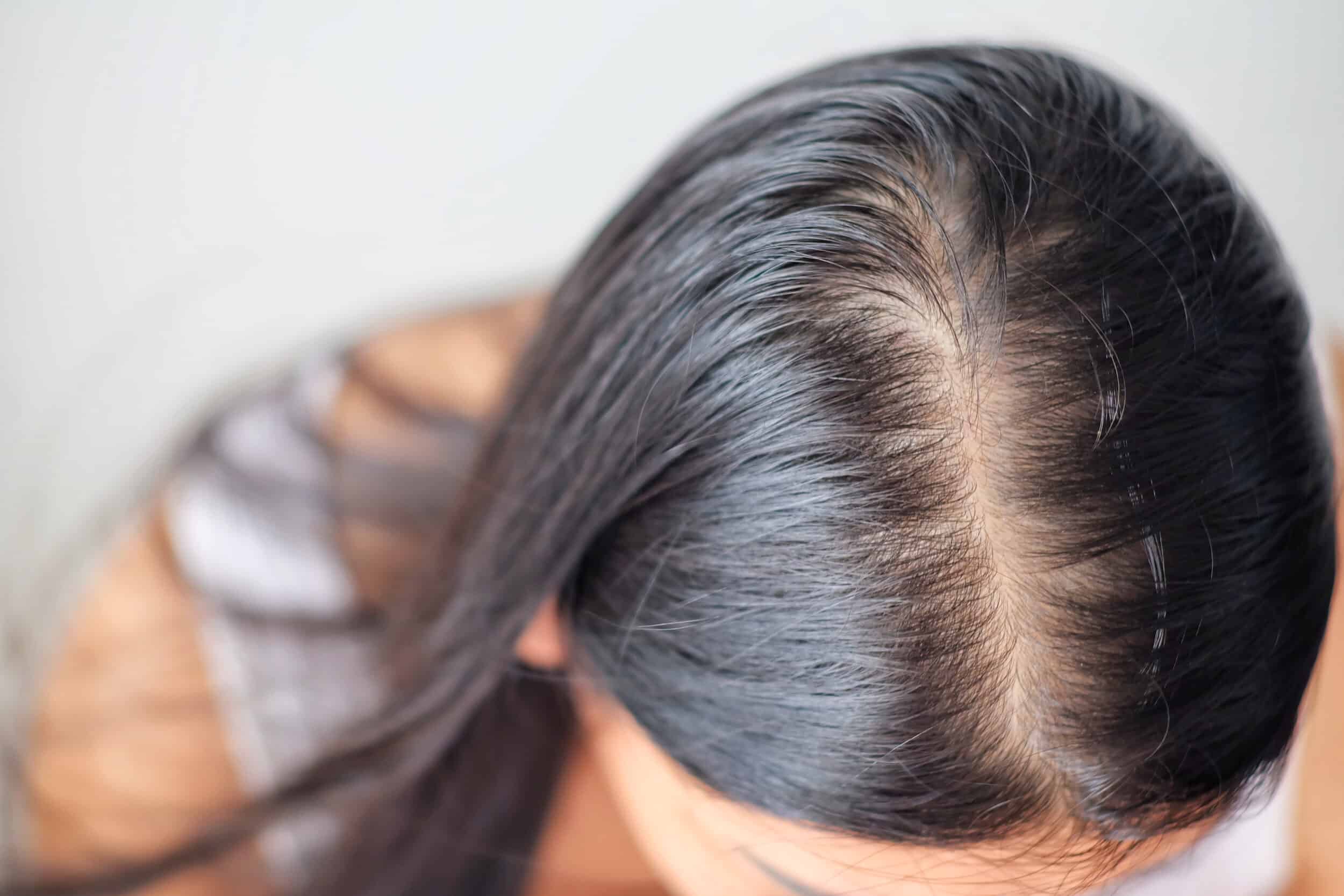 Top view of a woman with thinning hair along the part line, showing visible scalp and reduced hair density near the crown
