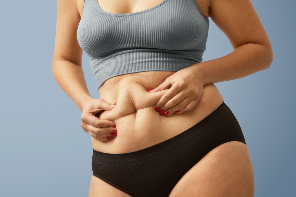 Woman pinching her midsection where she may be a candidate for high scar tummy tuck surgery.