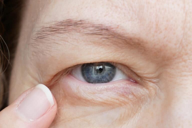 Older woman with aging eyelids who may benefit from blepharoplasty.