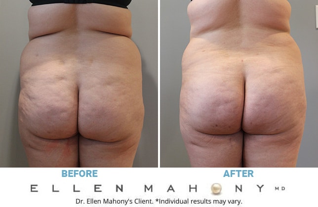 Before and After Image: Case #10817 - back