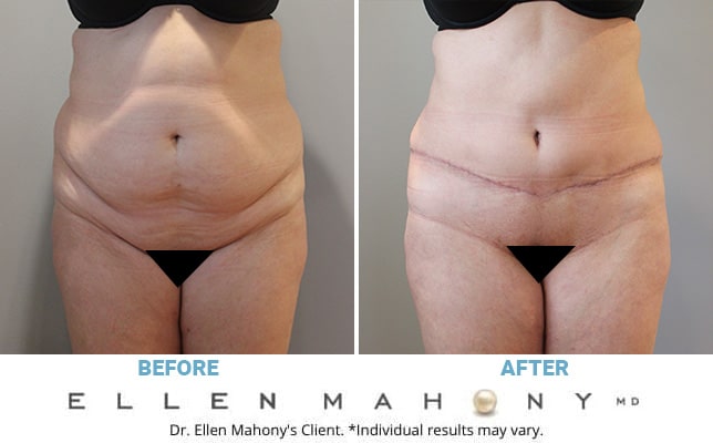 Before and After Image: Case #10817 - front