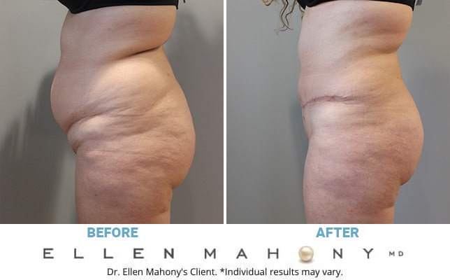 Before and After Image: Case #10817 - left-side
