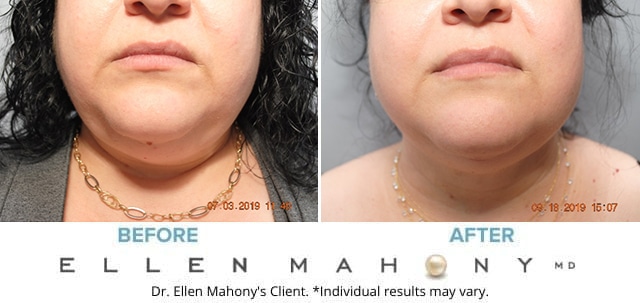 Before and After Image: Case #8347 - front