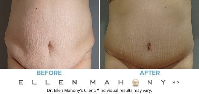 Before and After Image: Case #8347 - front