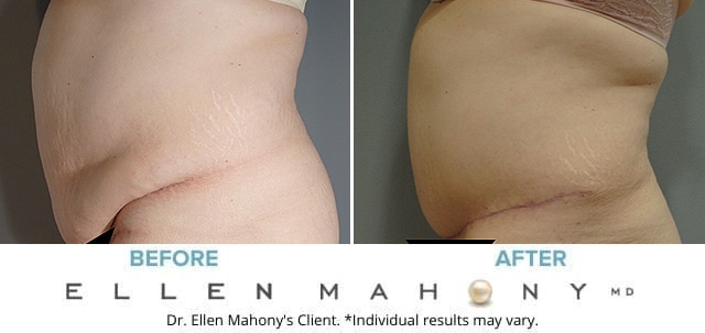 Before and After Image: Case #8347 - left-side