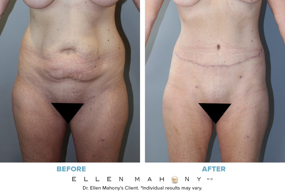 Before and After Image: Case #13695 - front