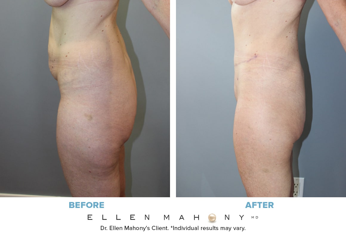 Before and After Image: Case #13695 - left-side