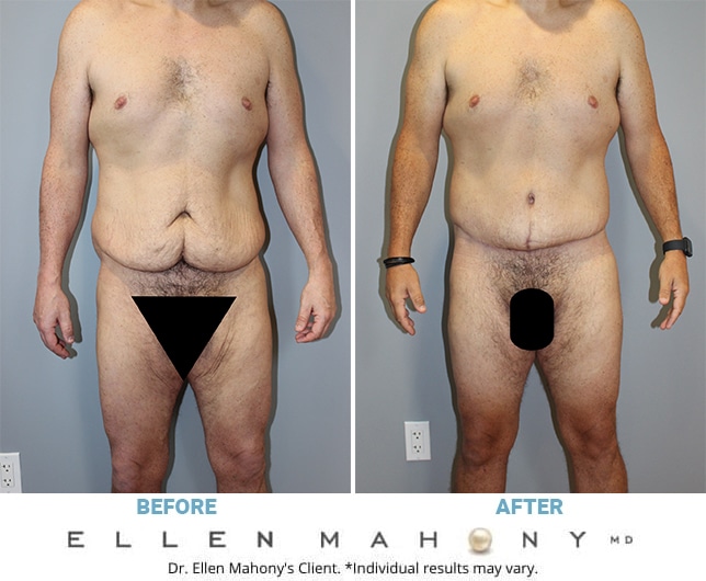Before and After Image: Case #11162 - front
