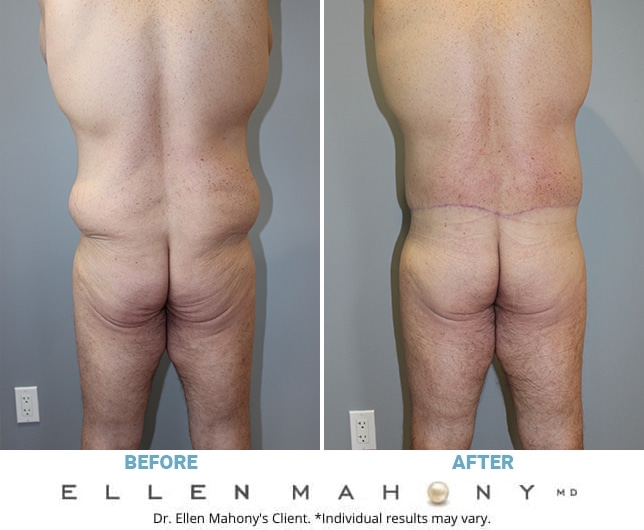 Before and After Image: Case #11162 - back