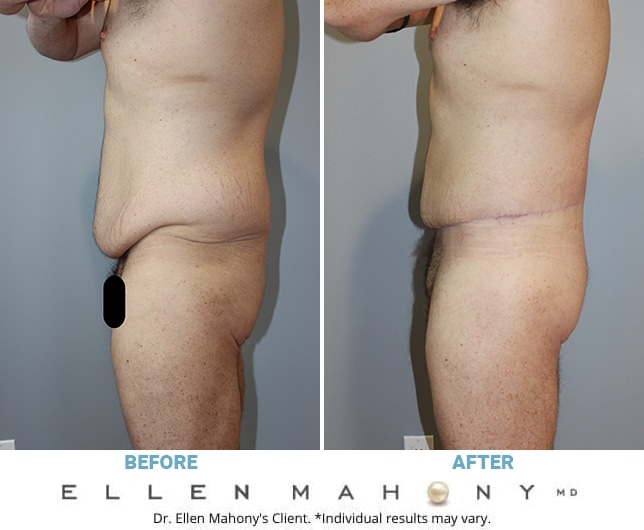 Before and After Image: Case #11162 - left-side
