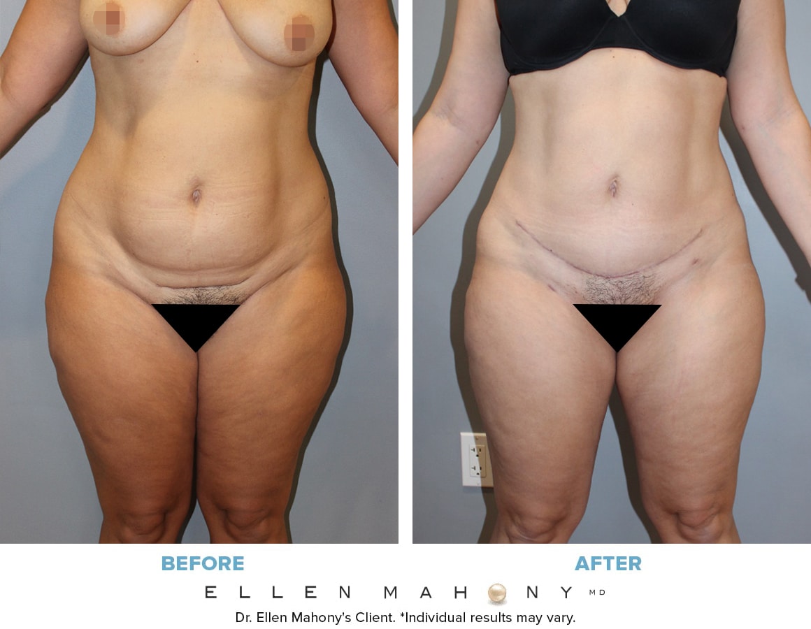 Before and After Image: Case #13081 - front