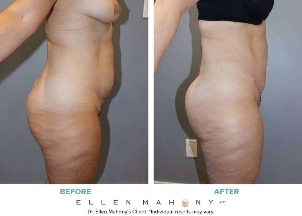 Before and After Image: Case #13081 - right-side