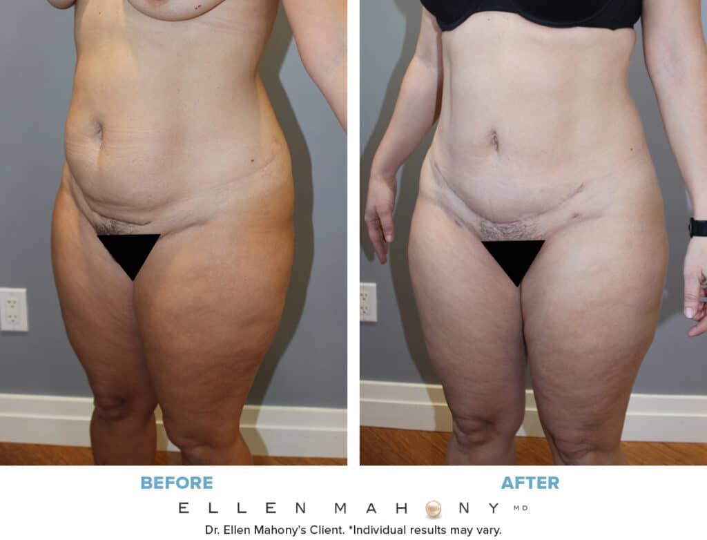 Before and After Image: Case #13081 - left-front-oblique