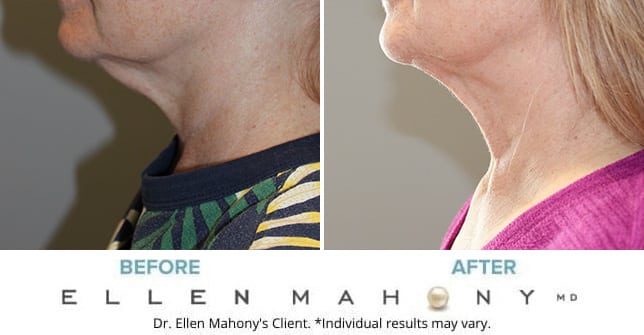 Before and After Image: Case #11566 - left-side