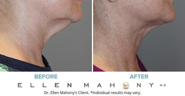 Before and After Image: Case #11566 - right-side