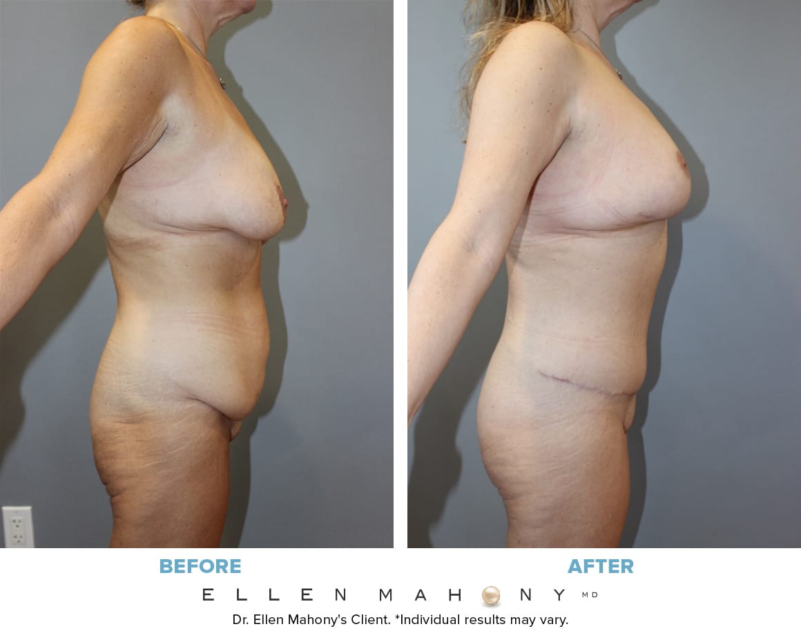 Before and After Image: Case #13398 - right-side