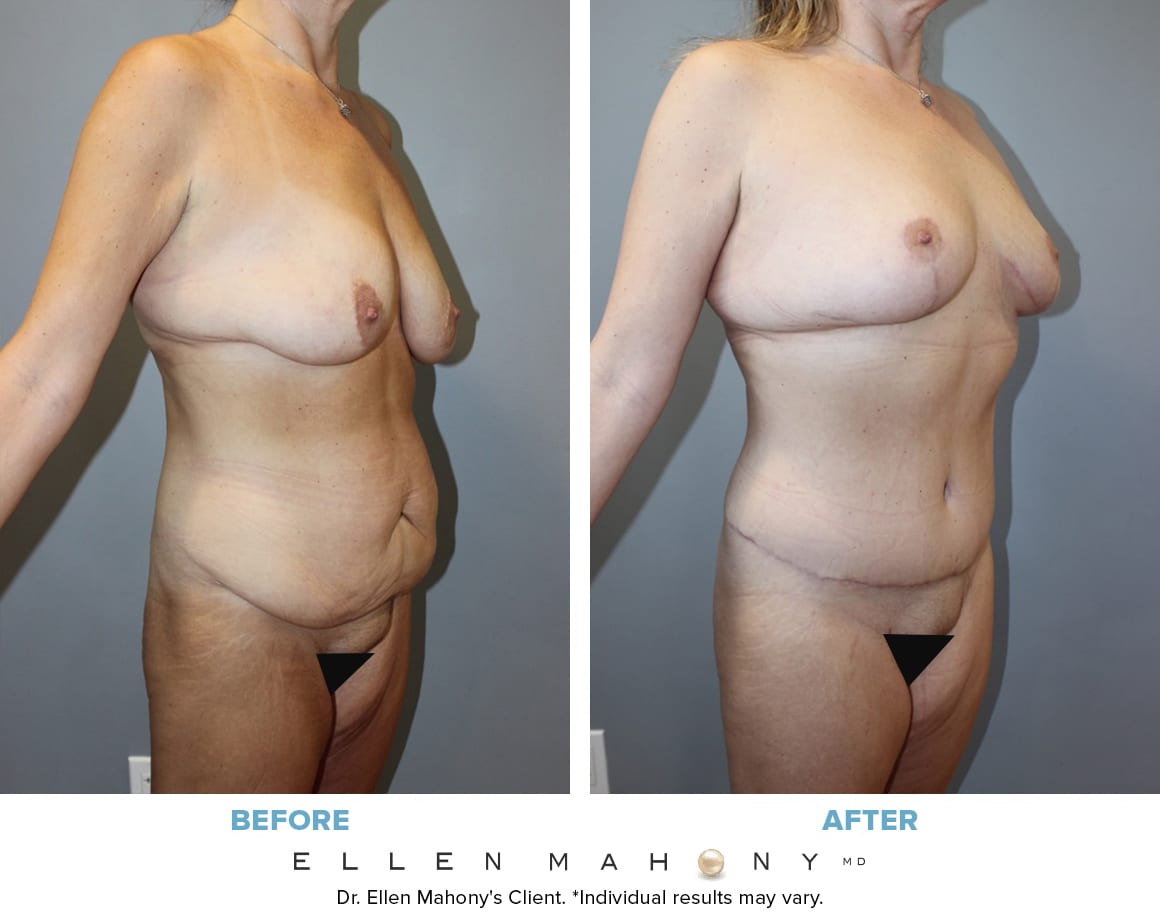 Before and After Image: Case #13398 - right-front-oblique