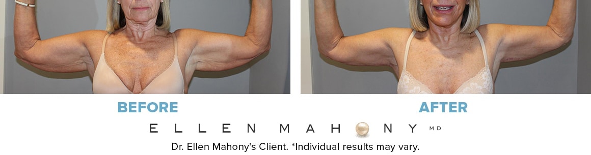 Before and After Image: Case #10012 - back