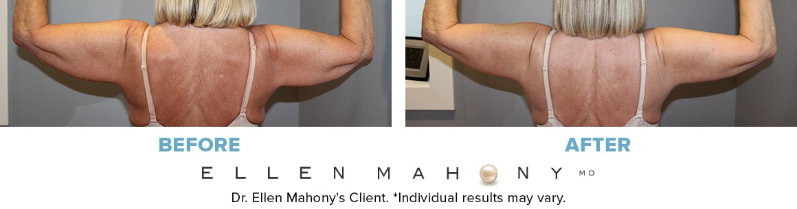Before and After Image: Case #10012 - back