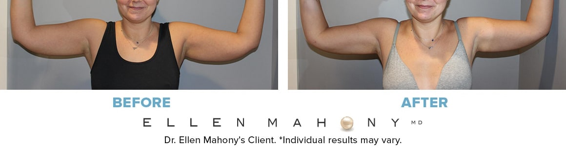 Before and After Image: Case #14283 - front