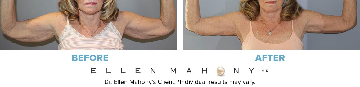 Before and After Image: Case #14604 - front