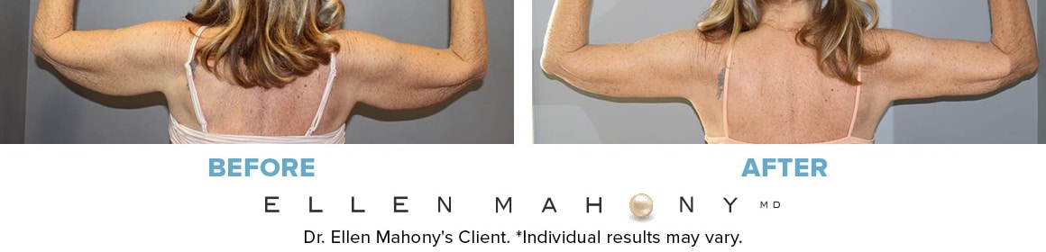 Before and After Image: Case #14604 - front