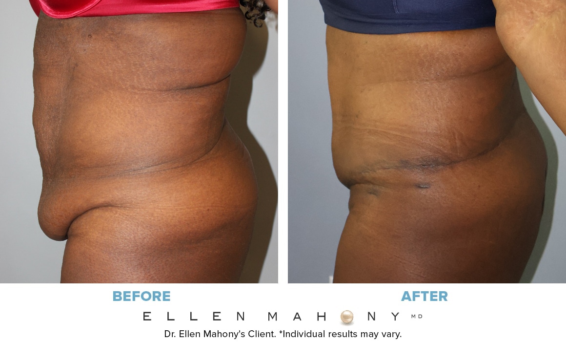 Before and After Image: Case #14589 - left-side