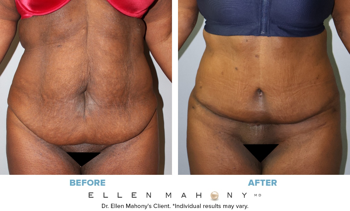 Before and After Image: Case #14589 - front