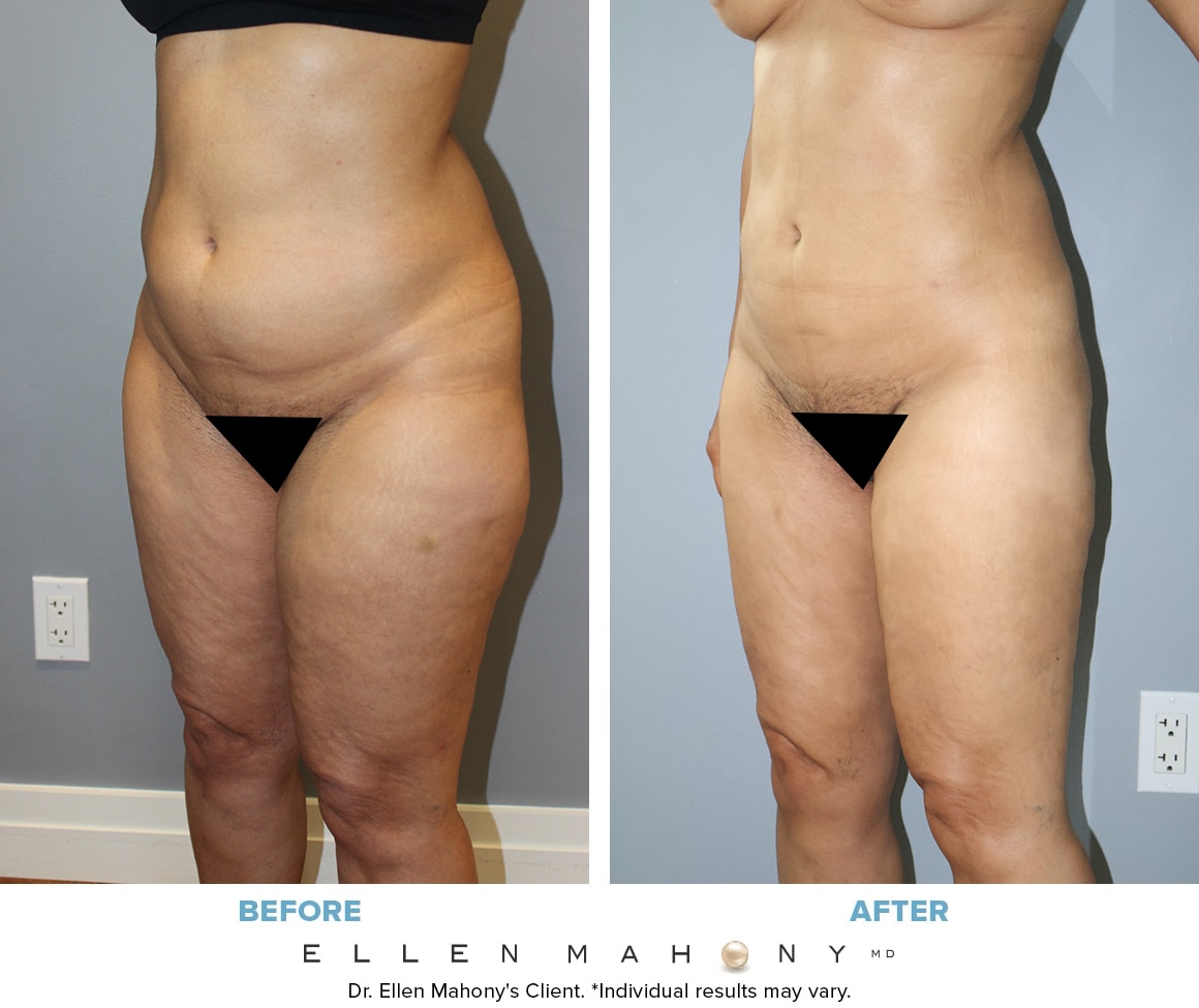 Before and After Image: Case #14660 - front