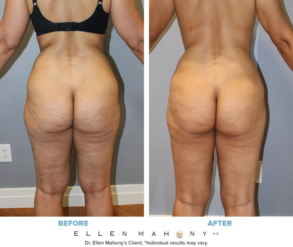 Before and After Image: Case #14660 - back