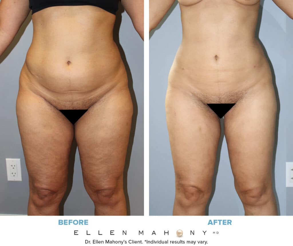 Before and After Image: Case #14660 - front