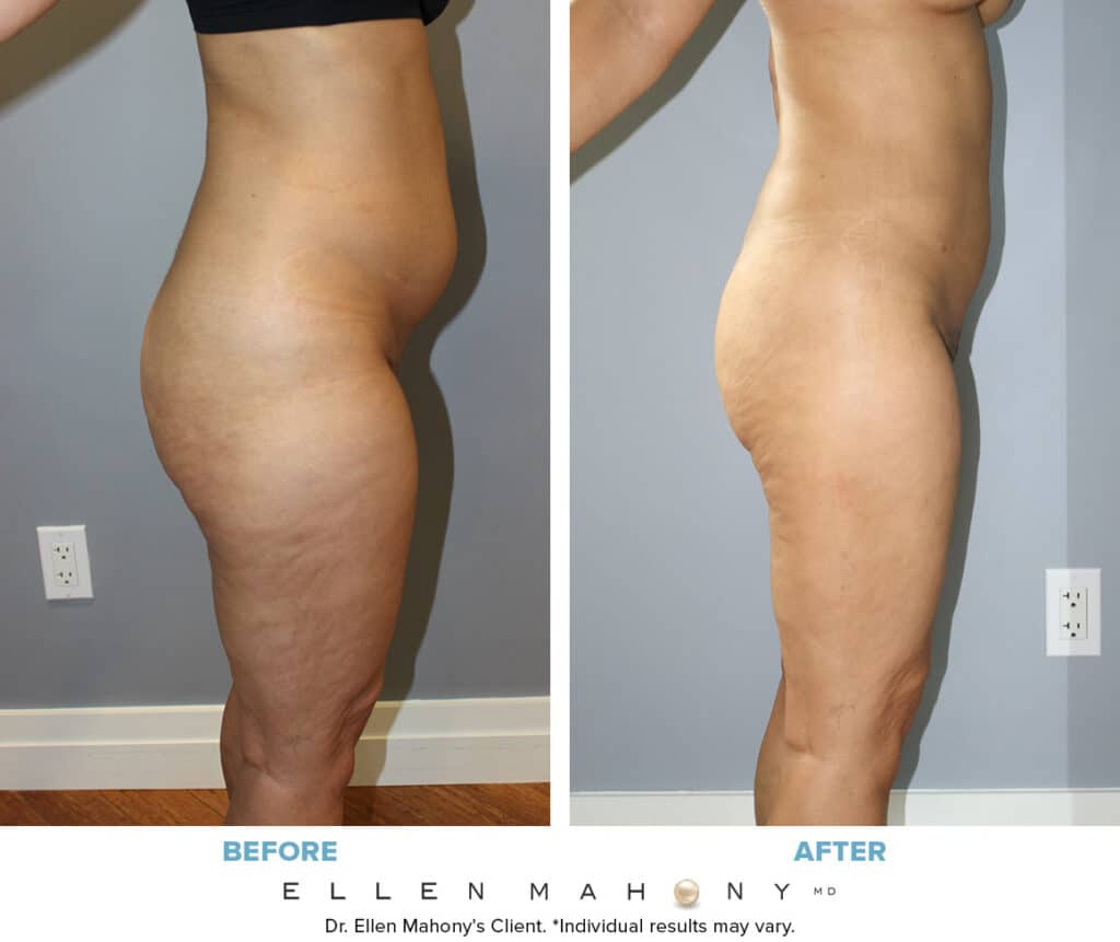 Before and After Image: Case #14660 - right-side