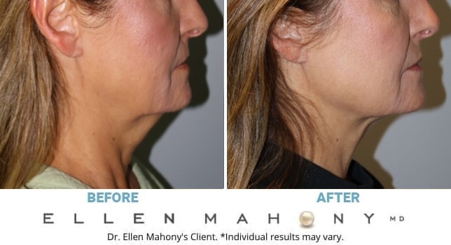 Before and After Image: Case #14799 - right-side