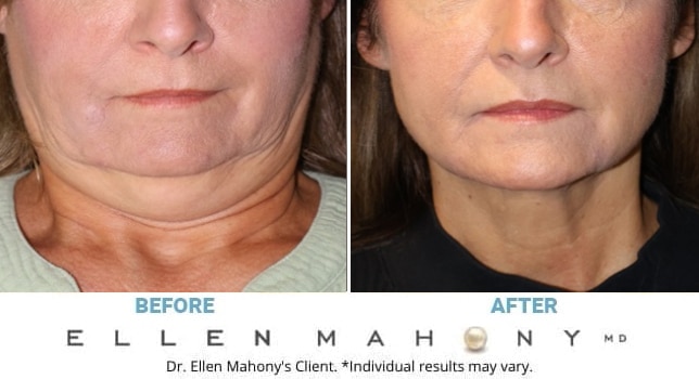 Before and After Image: Case #14799 - front