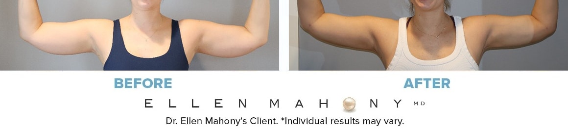 Before and After Image: Case #14566 - front