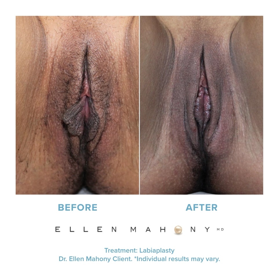 Before and After Image: Case #20910 - front