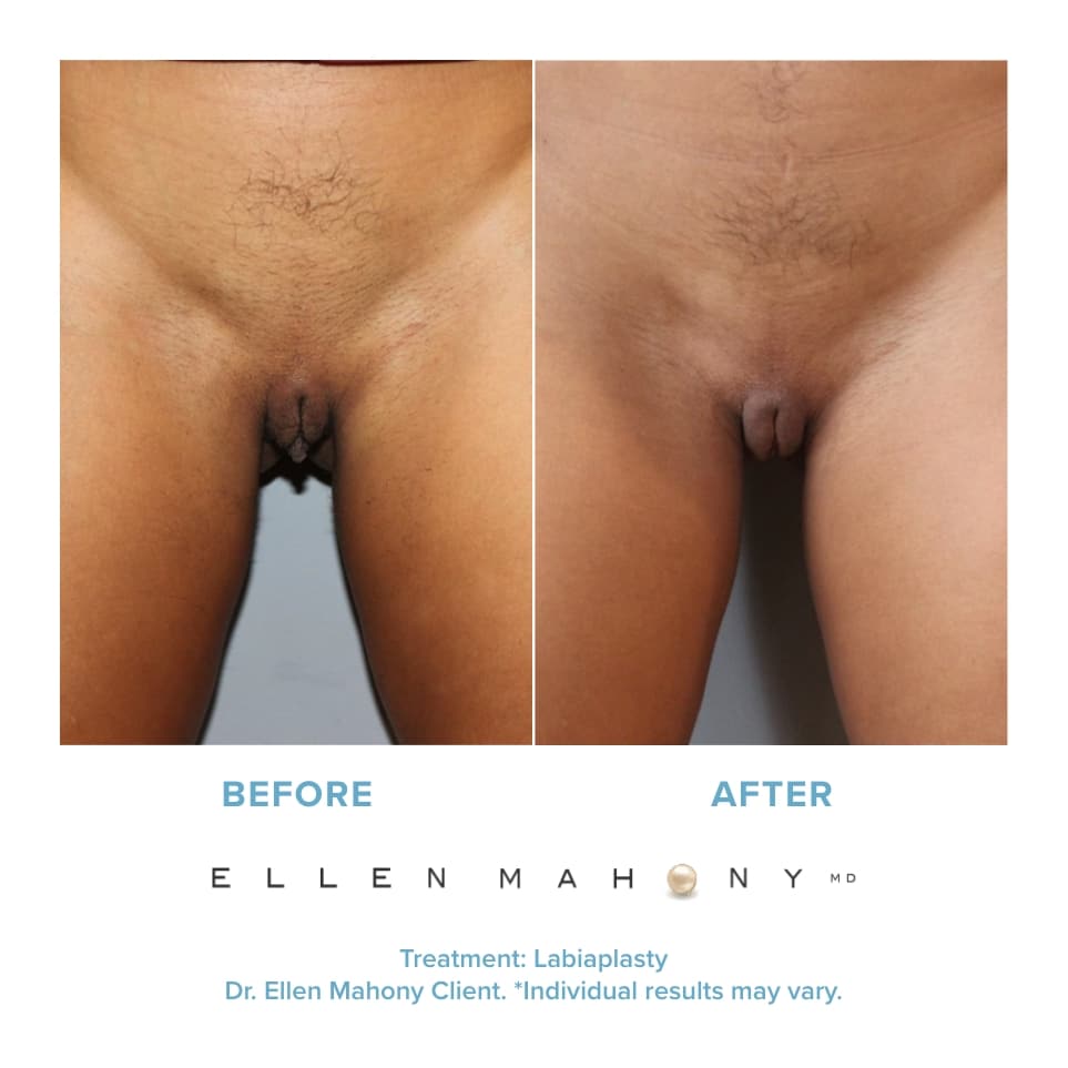 Before and After Image: Case #20910 - front