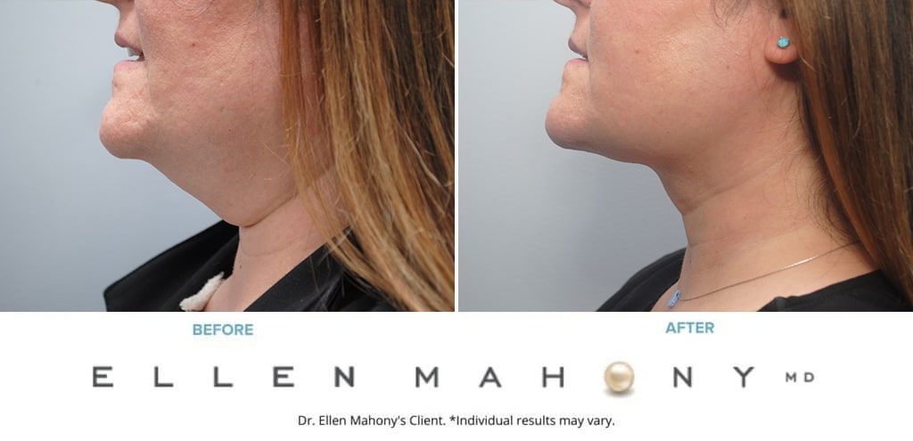 Before and After Image: Case #9665 - left-side