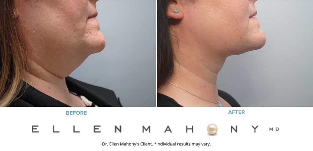 Before and After Image: Case #9665 - right-side
