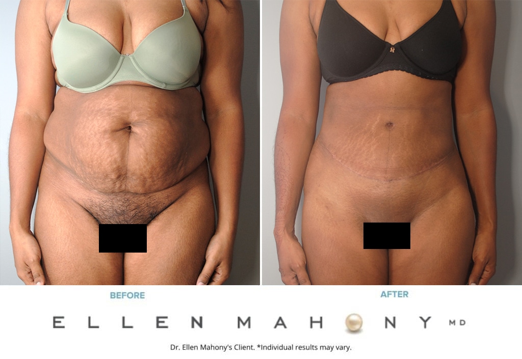 Before and After Image: Case #9968 - front