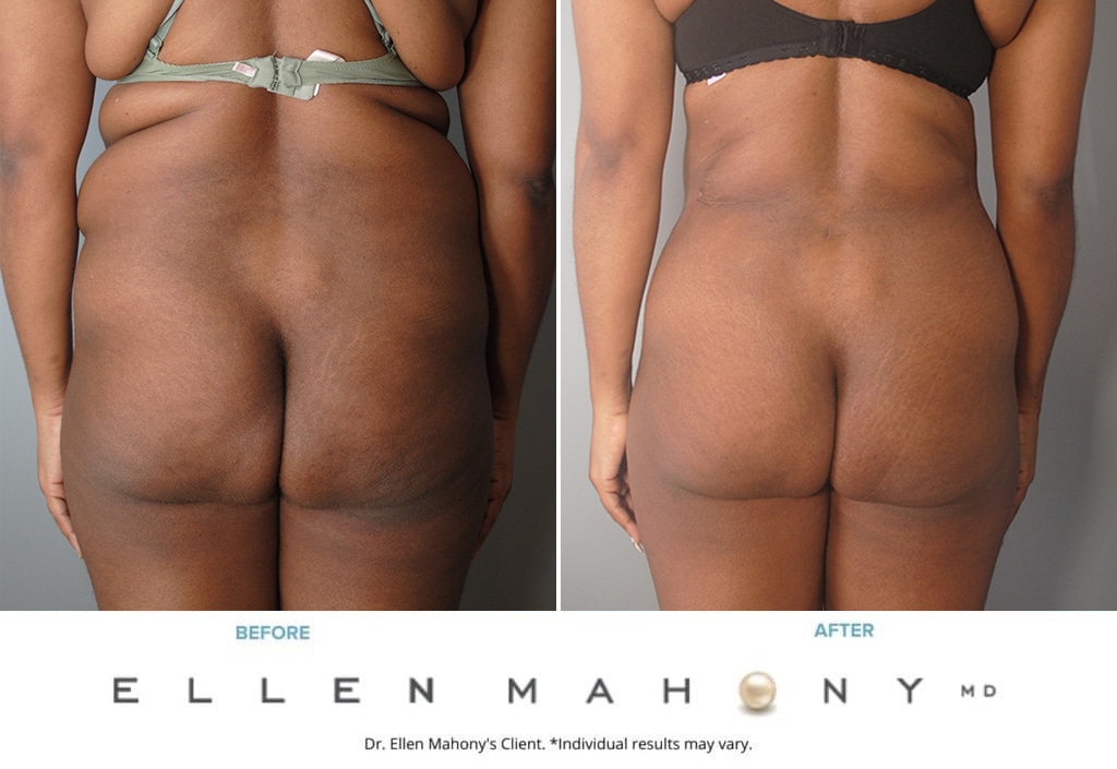 Before and After Image: Case #9968 - back