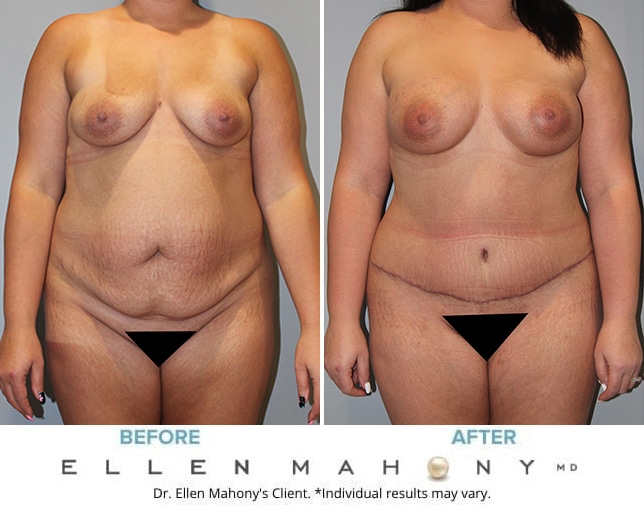 Before and After Image: Case #10119 - left-side