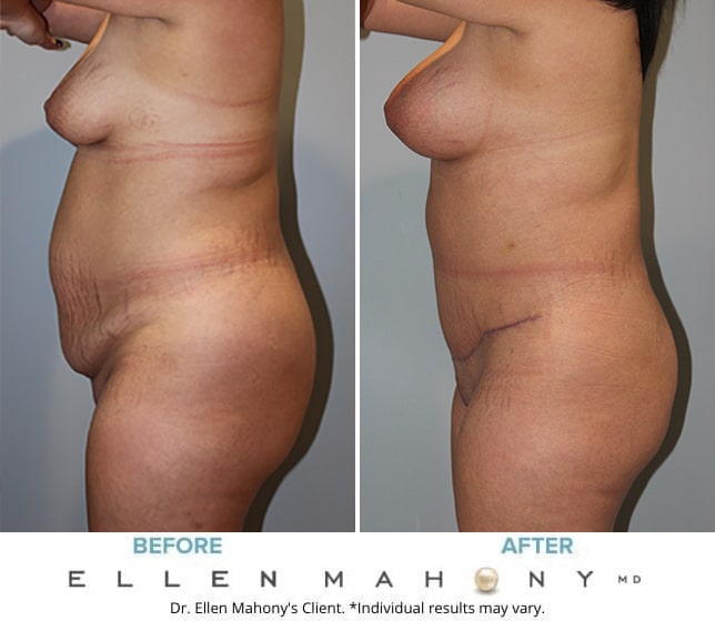 Before and After Image: Case #10119 - left-side