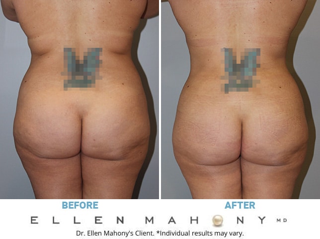 Before and After Image: Case #10601 - back